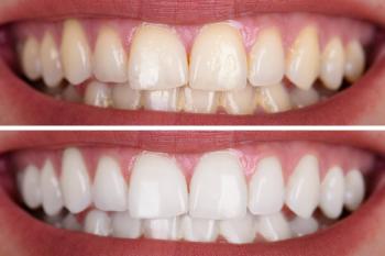 Branqueamento Dentário