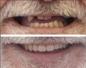 Dentes num só dia / 24 horas