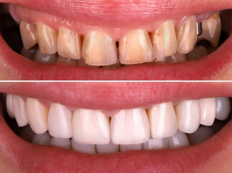 Prótese Fixa RisusClinic