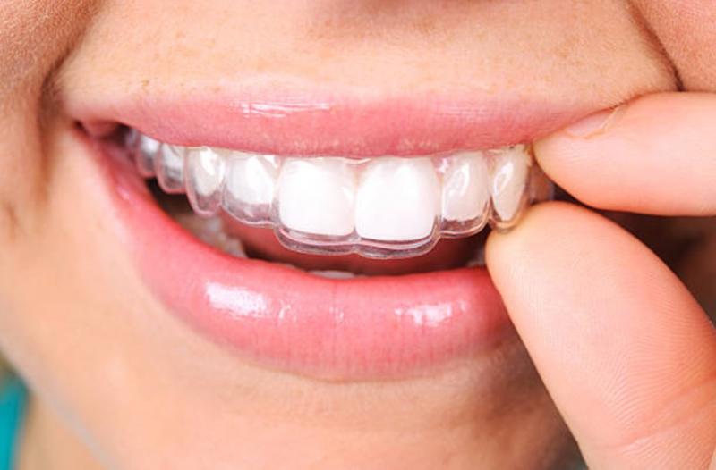 Alinhadores Invisíveis RisusClinic