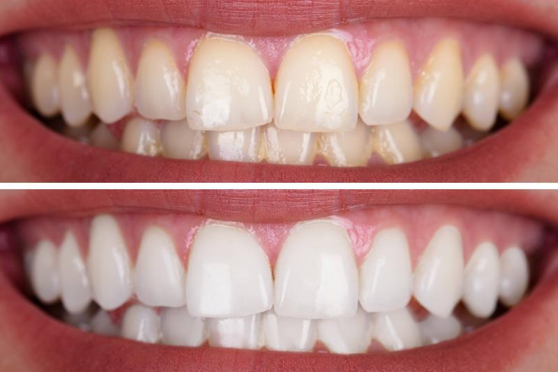 Branqueamento Dentário RisusClinic
