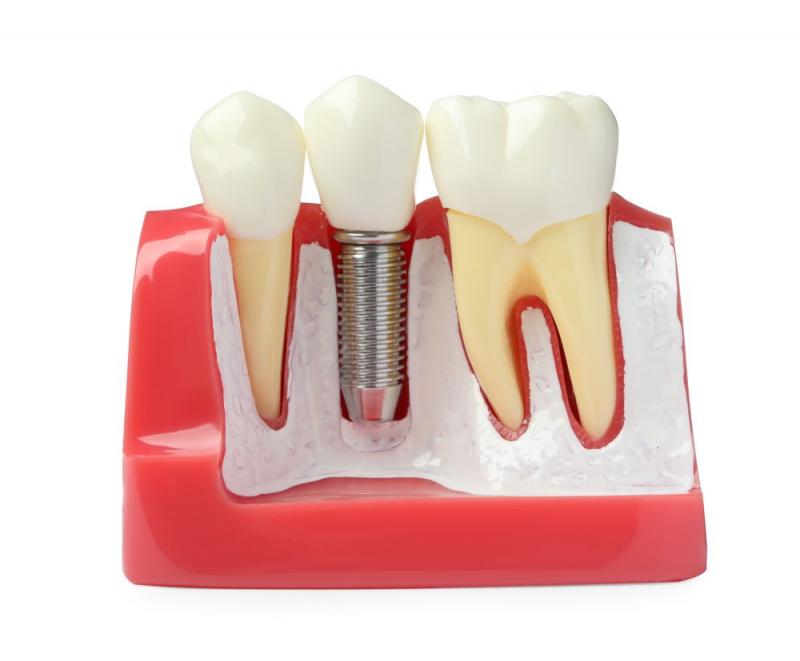 Implantologia RisusClinic